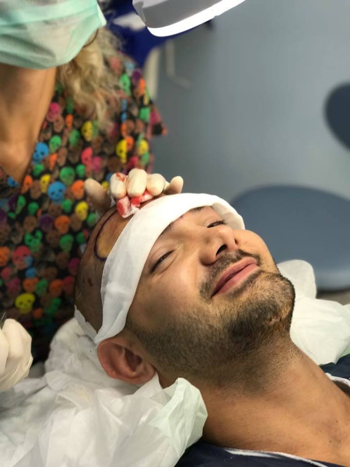 Haartransplantatie