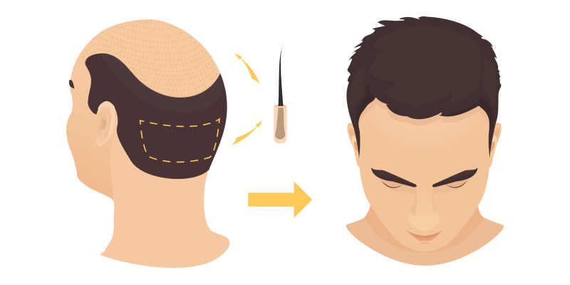 Haartransplantatie