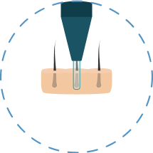 Haartransplantatie